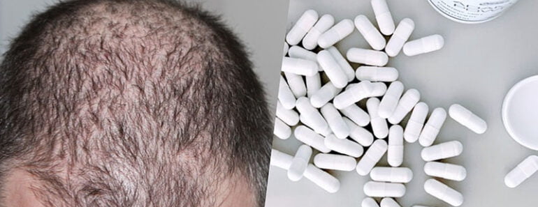 I Migliori Integratori per Capelli del 2026: i 5 Integratori per Capelli Migliori a Confronto